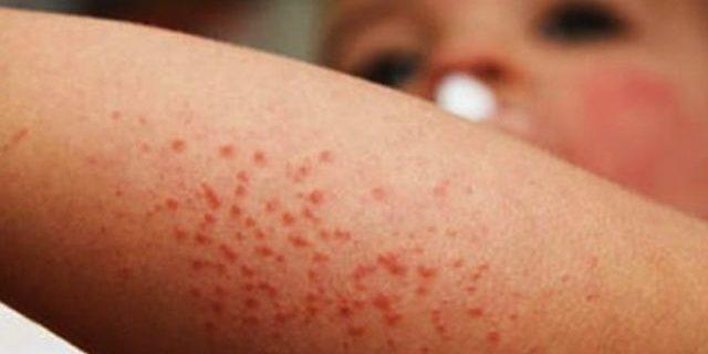 Implementan medidas preventivas ante brote de virus Coxsackie en Primaria Octavio Paz