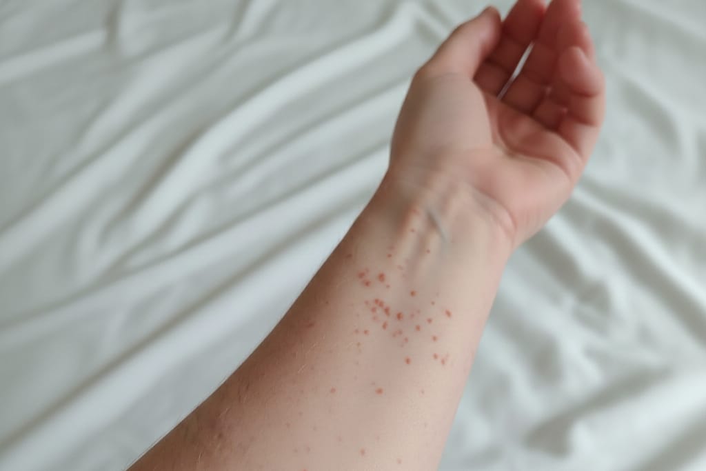 Confirman primera muerte por sarampión en México en 2026; alertan por brote activo