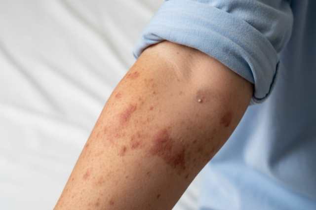 Puebla registra 102 casos confirmados de sarampión; 10 municipios presentan contagios